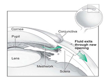 Conventional surgery